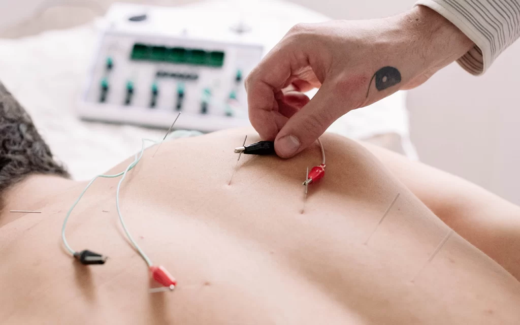 Unlocking Exercise Enhancements: The Science Behind Acupuncture, Electro-Acupuncture, Cupping, and Gua Sha