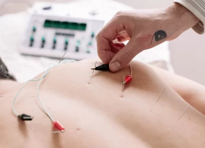 Unlocking Exercise Enhancements: The Science Behind Acupuncture, Electro-Acupuncture, Cupping, and Gua Sha